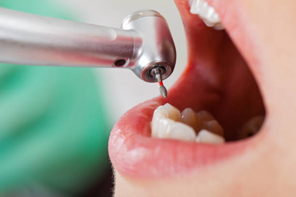 Best Broken or Cracked Tooth Emergency Dentist in Caseyvle, IL